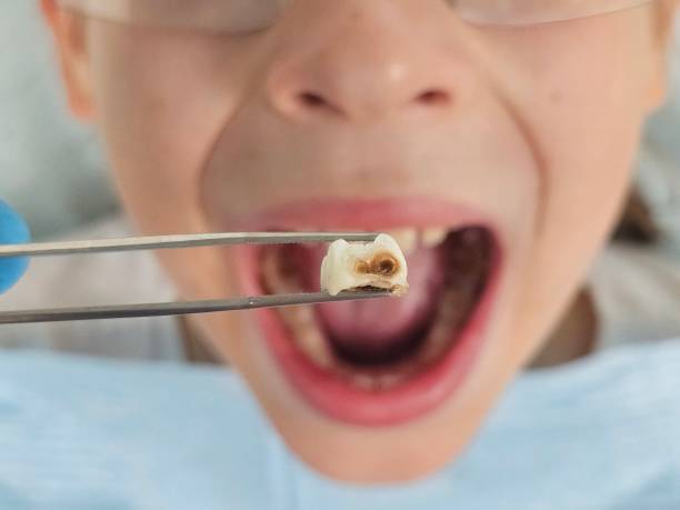 Best Knocked-Out Tooth (Avulsed Tooth) Treatment in Eleanor, WV